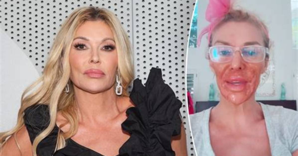 Brandi Glanville Nair Burn Incident: Timeline of the Reality Star’s Viral Video Revelation