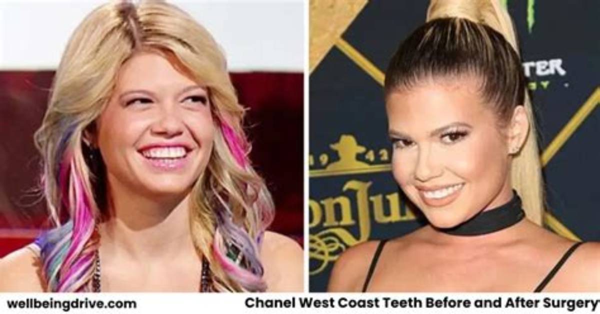 Chanel West Coast Teeth Before and After 2021: Visual Evidence and Procedure Breakdown