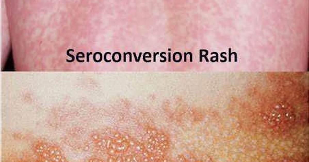 Complete Clinical Guide to Hiv Skin Rashes: Identification, Testing, and Care
