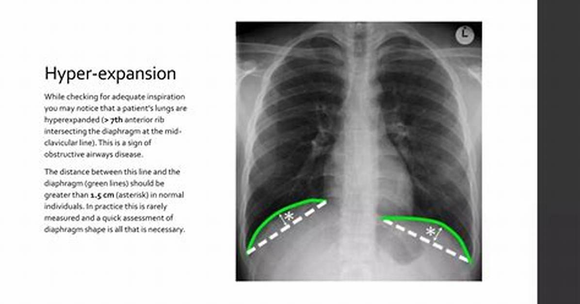 How Tall Is Clavicular? Fact-Checking Rumors, Claims, and Surgeries