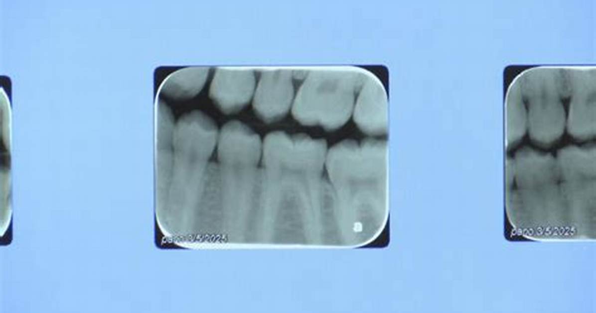 Madison Marks 12 Months Without Water Fluoride as Dental Warnings Escalate