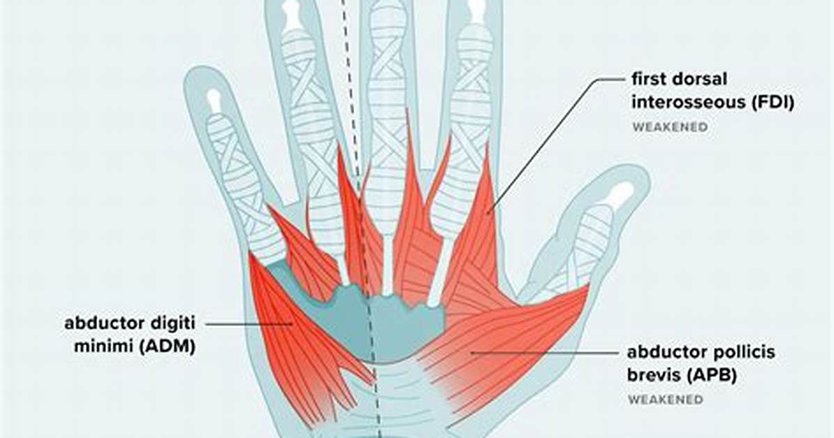 New Clinical Warnings on Hand Weakness: When Slipping Grip Signals Serious Nerve Trouble