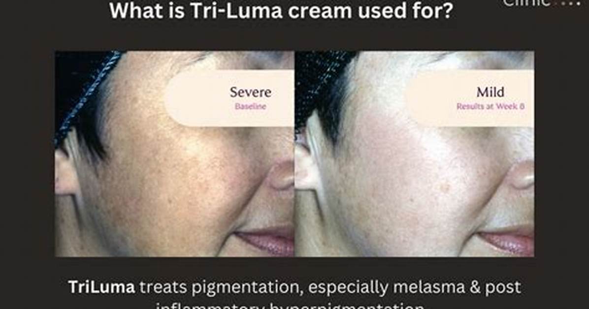 Tri-Luma Cream Before and After: Clinical Results on Stubborn Melasma