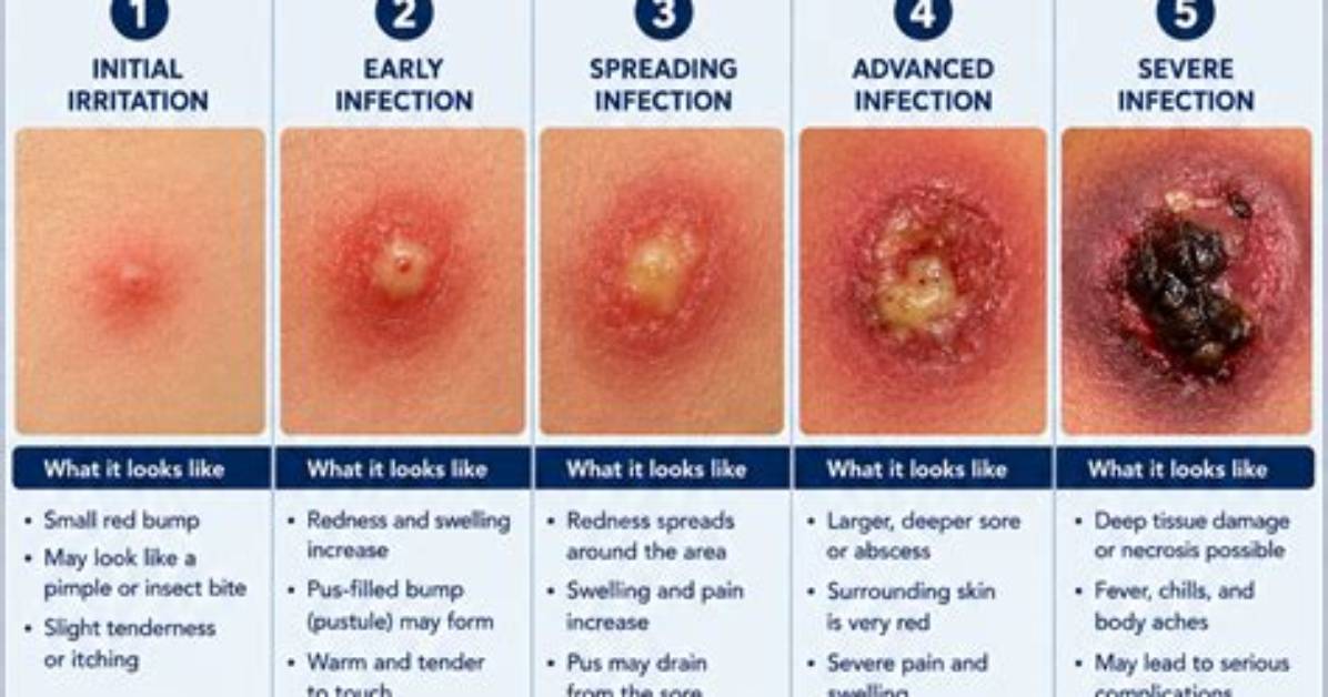 What Early Staph Looks Like: Key Visual Indicators and Skin Warning Signs