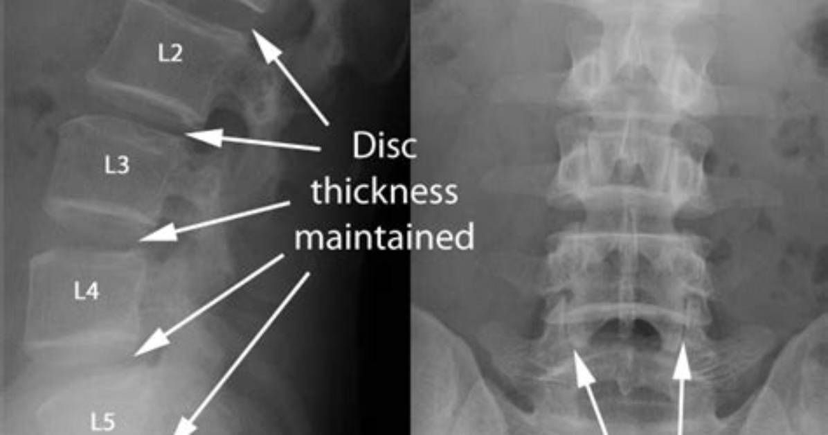 What Lumbago Looks Like on Scans: Anatomy of Acute Lower Back Pain